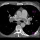 Acute lung embolism, massive: CT - Computed tomography